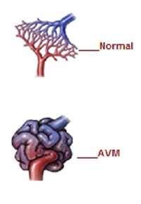 Spinal Arteriovenous Malformation Symptoms Causes Treatment