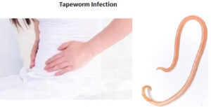 Tapeworm Infection Symptoms Causes Treatment