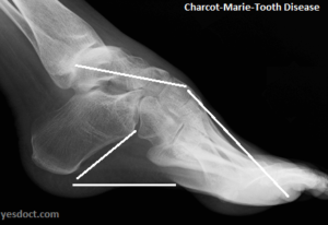 Charcot-Marie-Tooth Disease Symptoms Causes Treatment