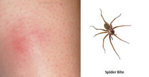 Spider Bite Symptoms Causes Treatment