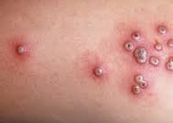 smallpox symptoms causes treatment