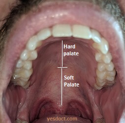 soft palate cancer symptoms causes treatment